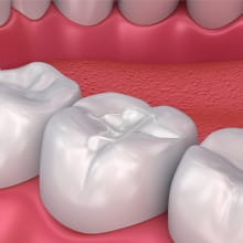 Image of Tooth Fillings