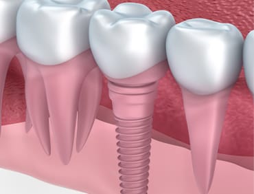 Image of a dental implant