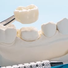 Image of restorative crowns