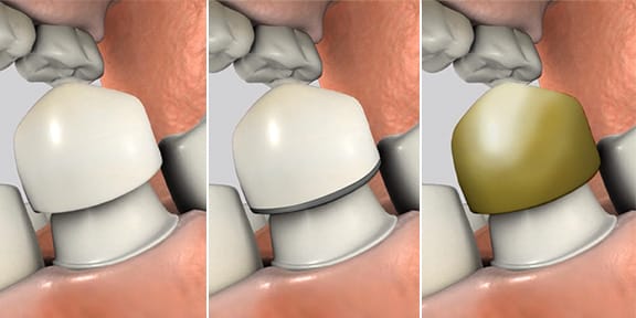 Types of Crowns